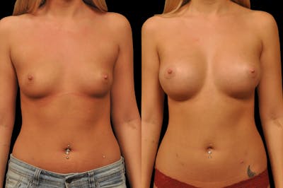 Breast Augmentation Before & After Gallery - Patient 142095 - Image 1