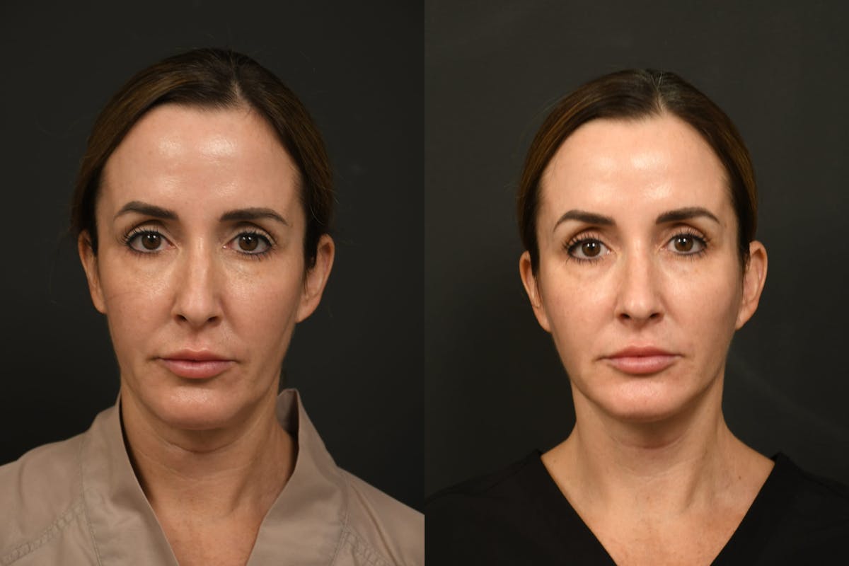 Changes Rapid Lift  Before & After Gallery - Patient 377971 - Image 3