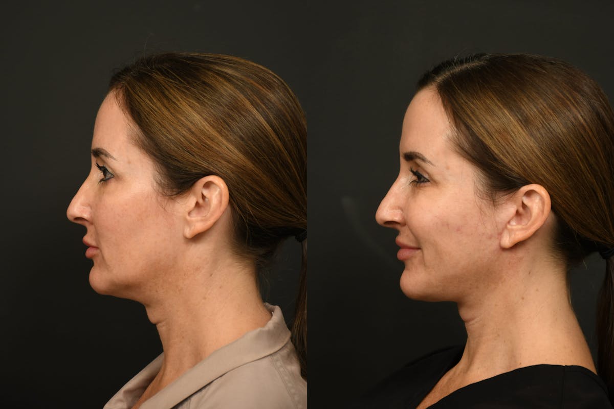 Changes Rapid Lift  Before & After Gallery - Patient 377971 - Image 2