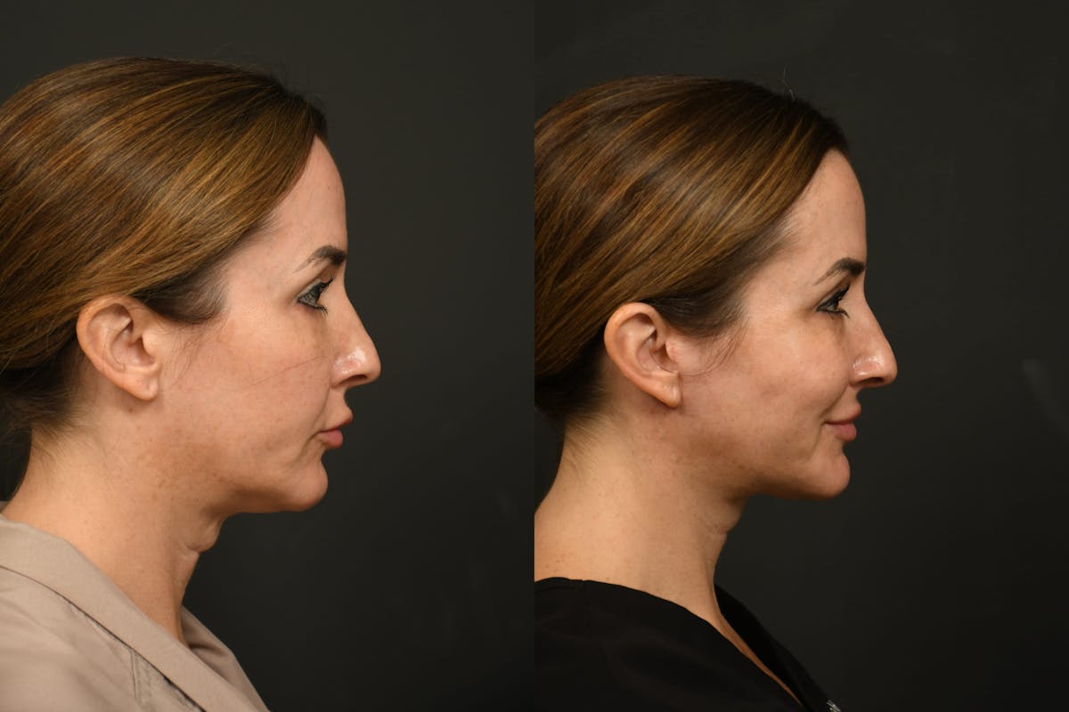 Changes Rapid Lift  Before & After Gallery - Patient 377971 - Image 4