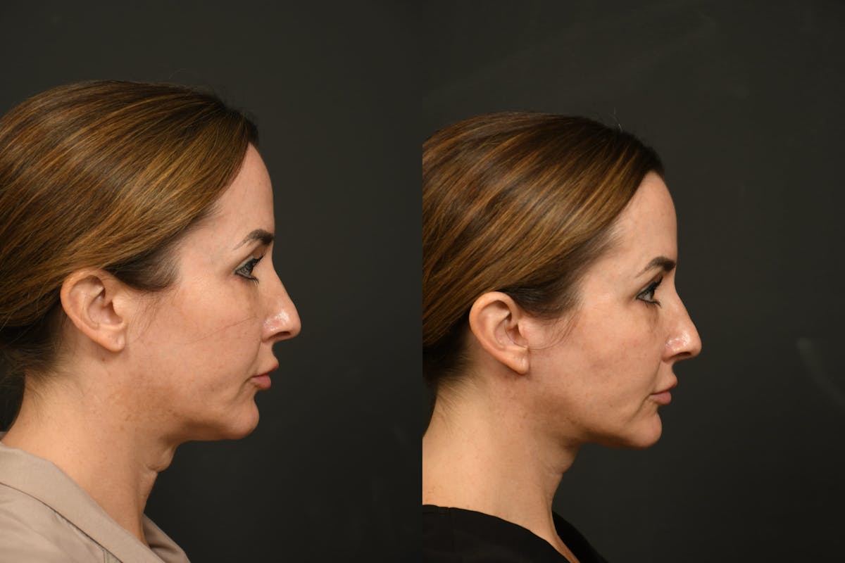 Changes Rapid Lift  Before & After Gallery - Patient 377971 - Image 6