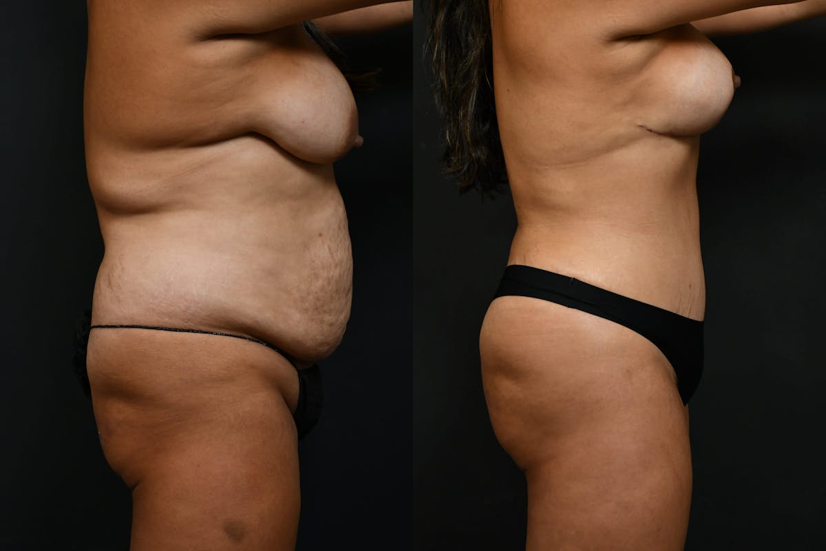 Butt Augmentation Before & After Gallery - Patient 206344 - Image 3