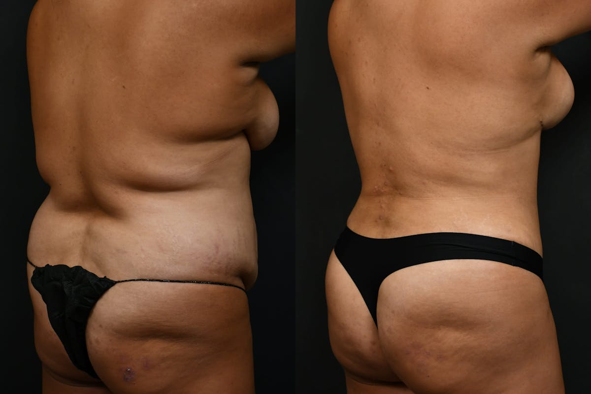 Butt Augmentation Before & After Gallery - Patient 206344 - Image 2