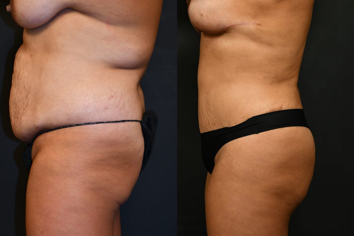 Fat Grafting - Butt Augmentation Before & After Gallery - Patient 206344 - Image 5