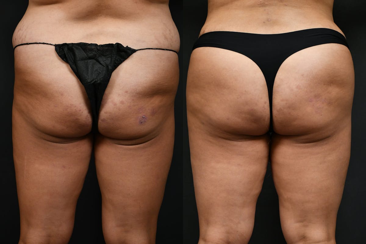 Butt Augmentation Before & After Gallery - Patient 206344 - Image 6
