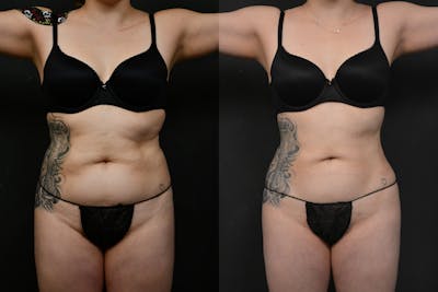 Liposuction / BodyTite Before & After Gallery - Patient 173464 - Image 1