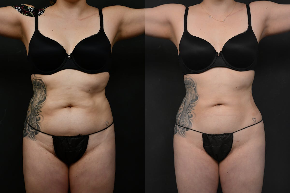 Liposuction Before & After Gallery - Patient 173464 - Image 1