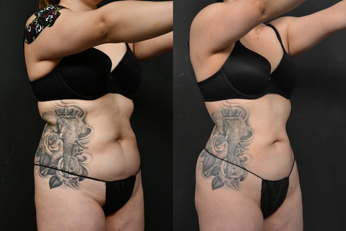 Liposuction Before & After Gallery - Patient 173464 - Image 2