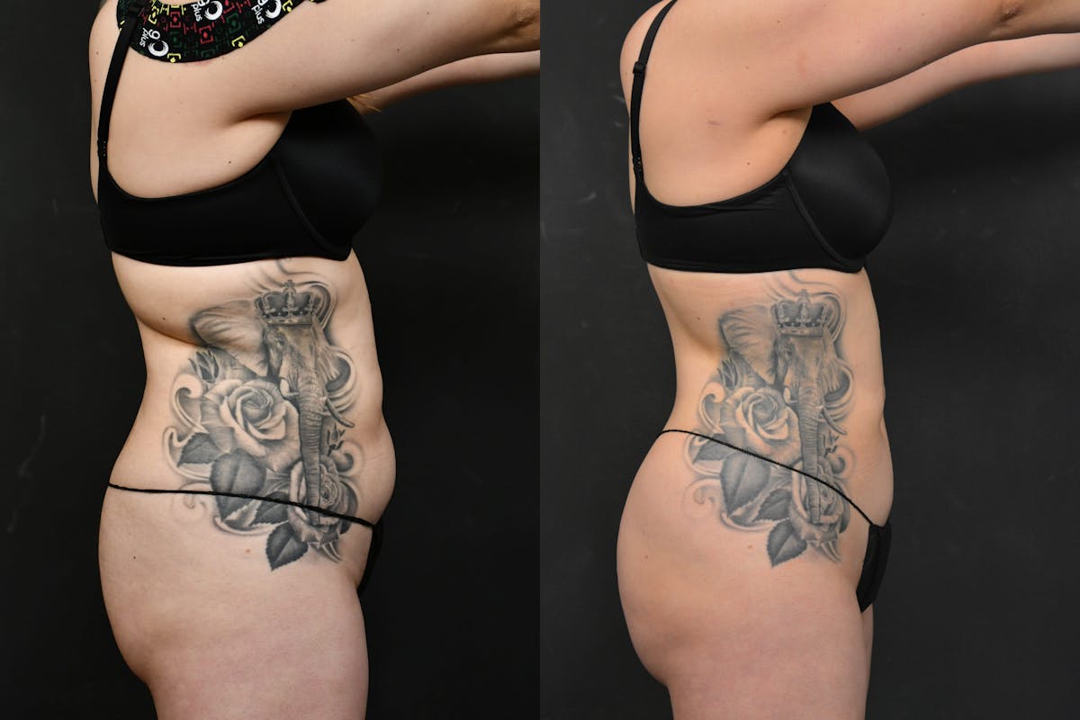 Liposuction / BodyTite Before & After Gallery - Patient 173464 - Image 3