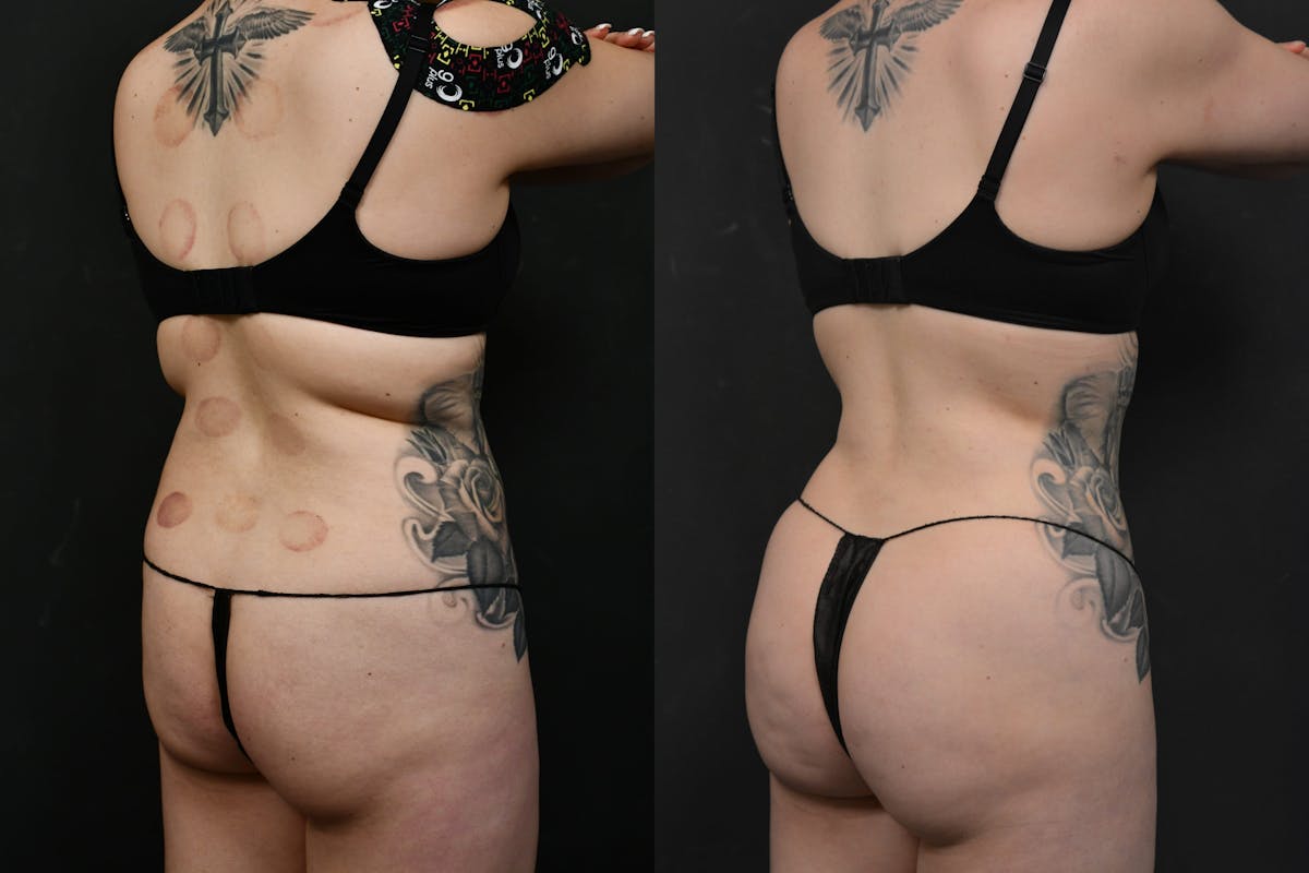 Butt Augmentation Before & After Gallery - Patient 290479 - Image 2