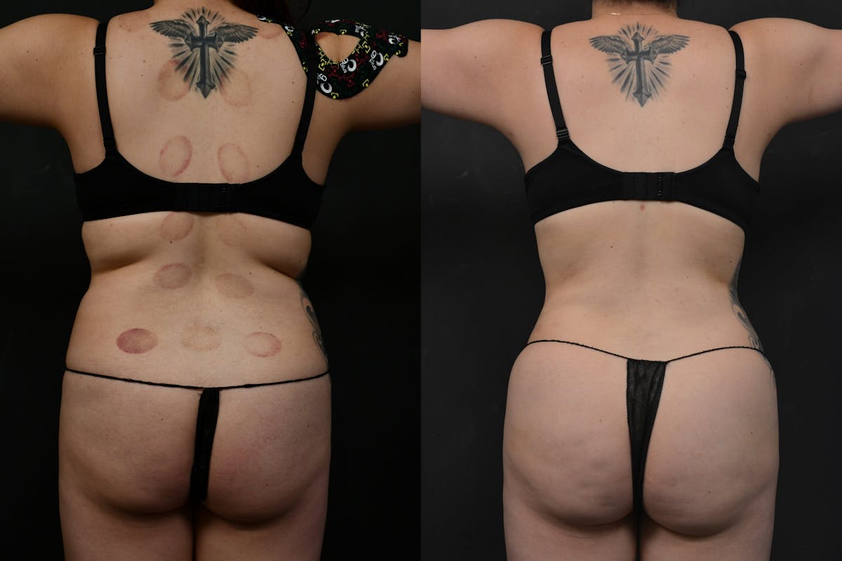 Liposuction / BodyTite Before & After Gallery - Patient 173464 - Image 7