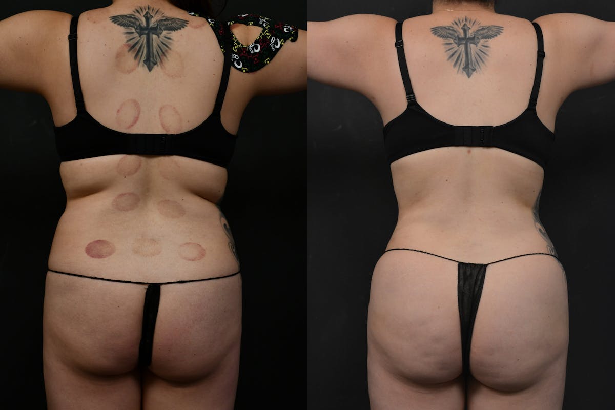 Butt Augmentation Before & After Gallery - Patient 290479 - Image 3