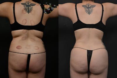 Butt Augmentation Before & After Gallery - Patient 290479 - Image 1
