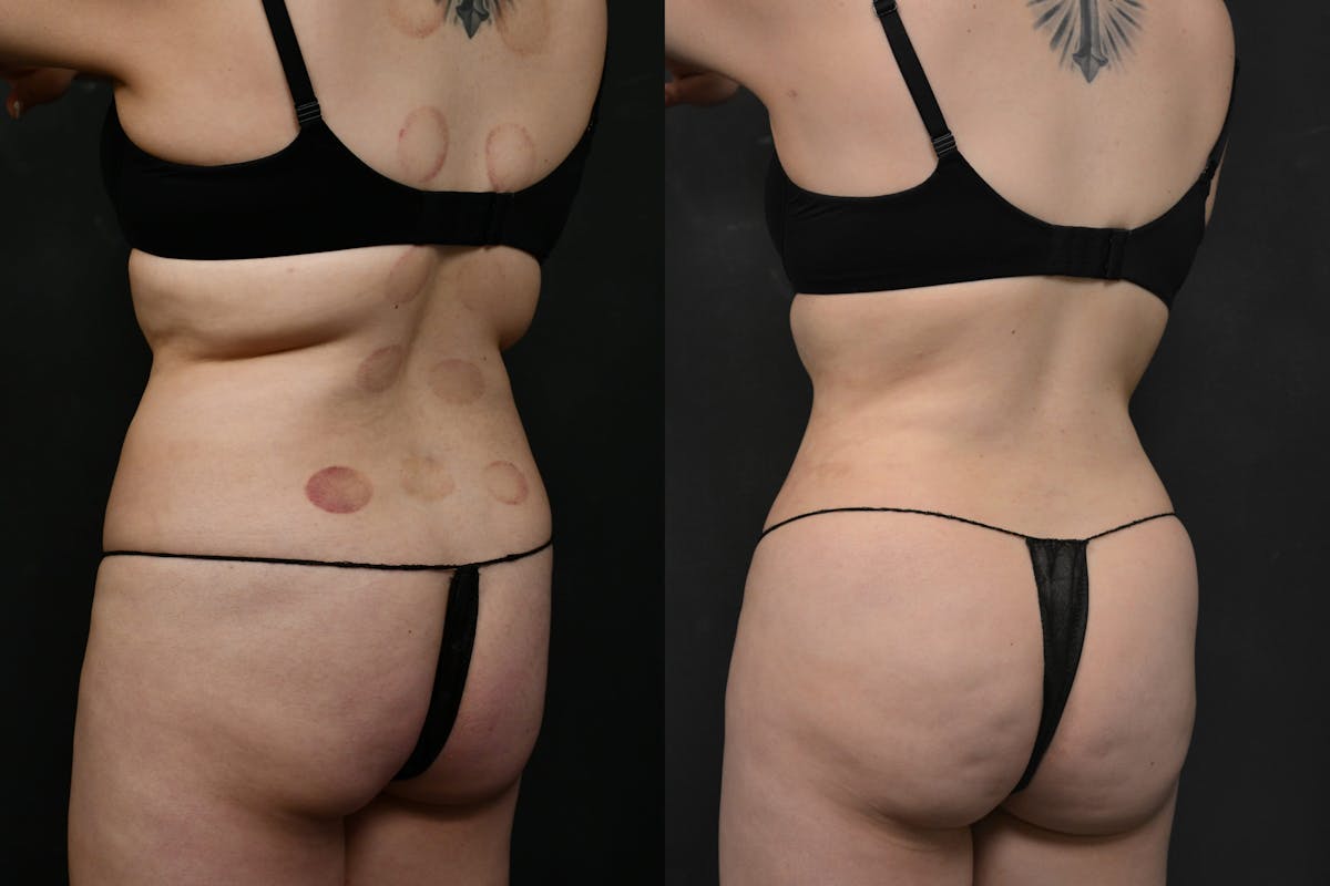 Butt Augmentation Before & After Gallery - Patient 290479 - Image 4