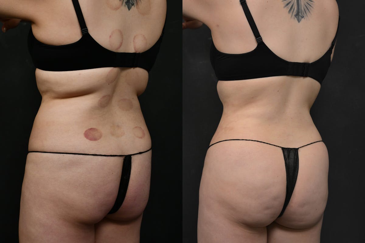 Butt Augmentation Before & After Gallery - Patient 290479 - Image 2