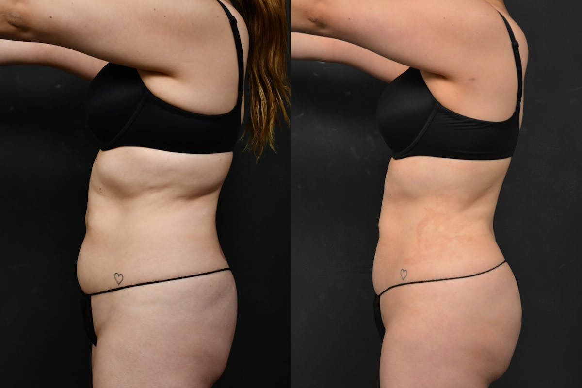 Butt Augmentation Before & After Gallery - Patient 290479 - Image 4
