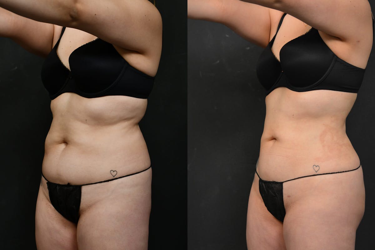 Liposuction / BodyTite Before & After Gallery - Patient 173464 - Image 4
