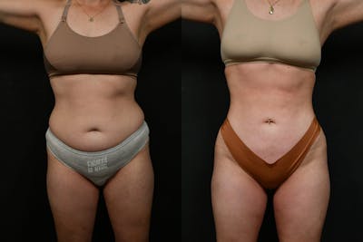 Liposuction / BodyTite Before & After Gallery - Patient 780294 - Image 1