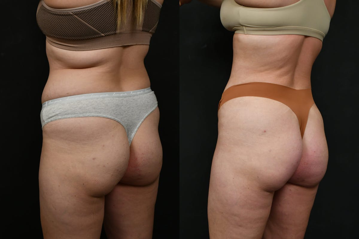 Butt Augmentation Before & After Gallery - Patient 413193 - Image 2