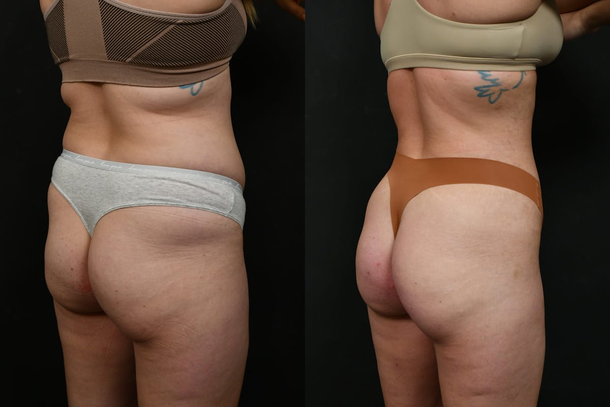 Butt Augmentation Before & After Gallery - Patient 413193 - Image 4