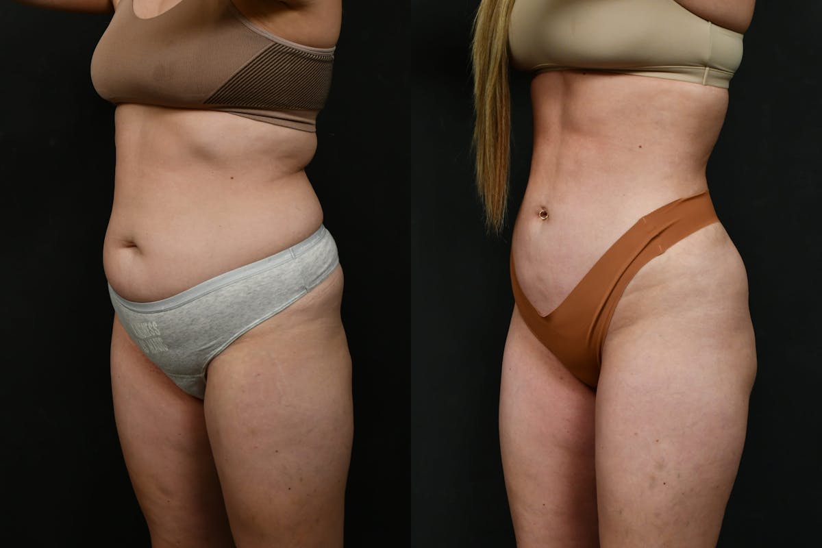 Liposuction / BodyTite Before & After Gallery - Patient 780294 - Image 2