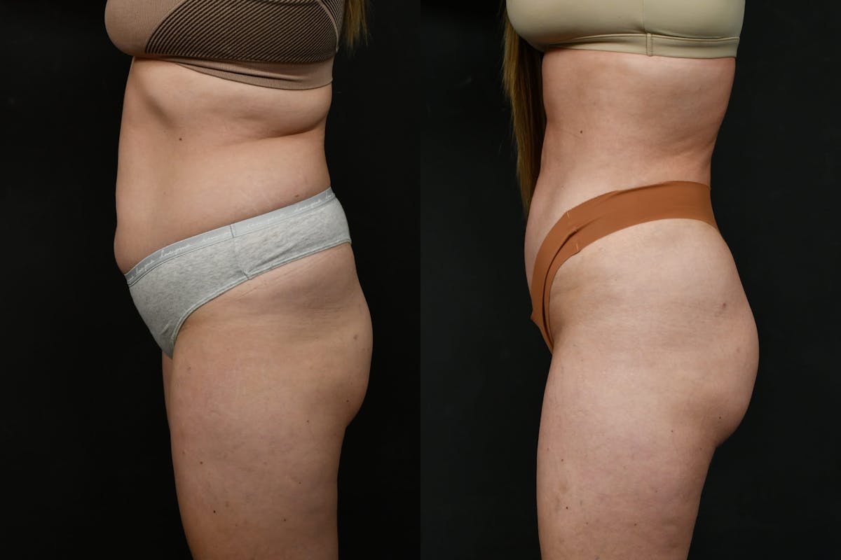 Butt Augmentation Before & After Gallery - Patient 413193 - Image 3