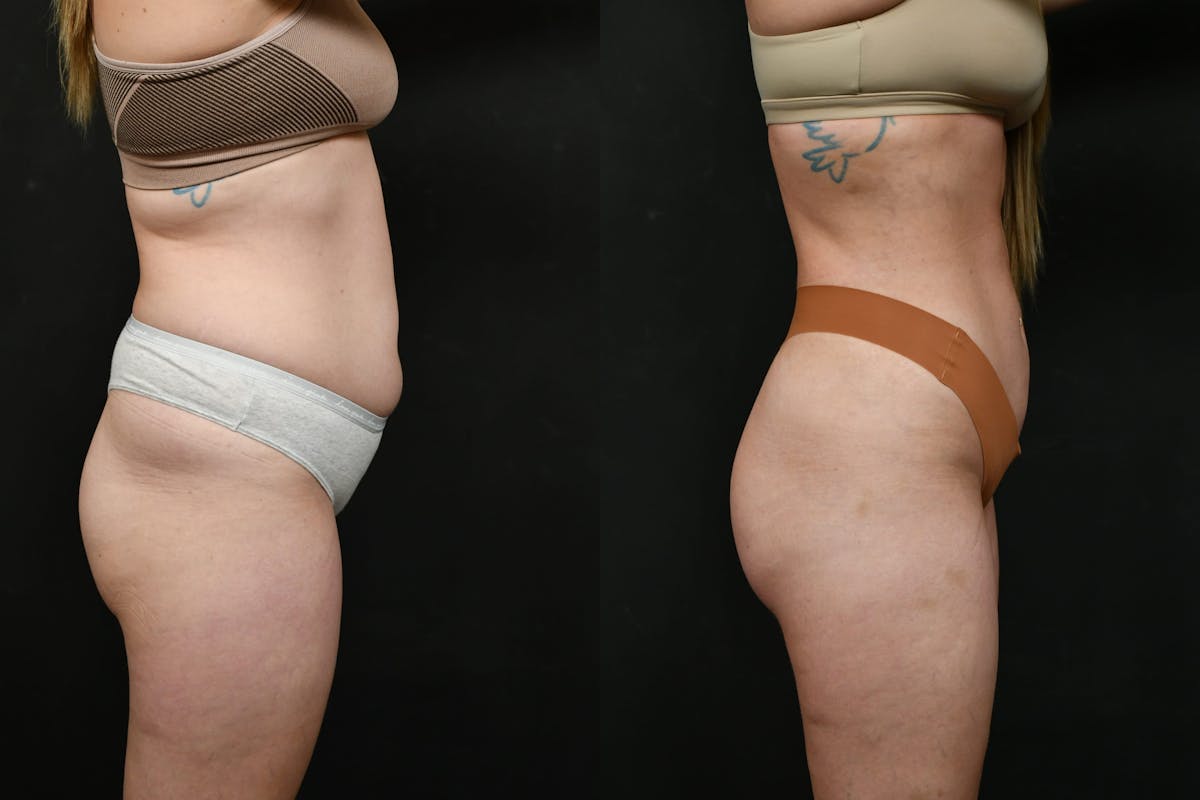 Butt Augmentation Before & After Gallery - Patient 413193 - Image 5