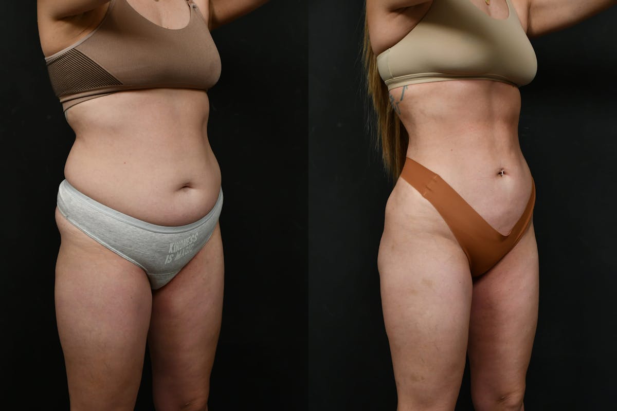 Liposuction / BodyTite Before & After Gallery - Patient 780294 - Image 4