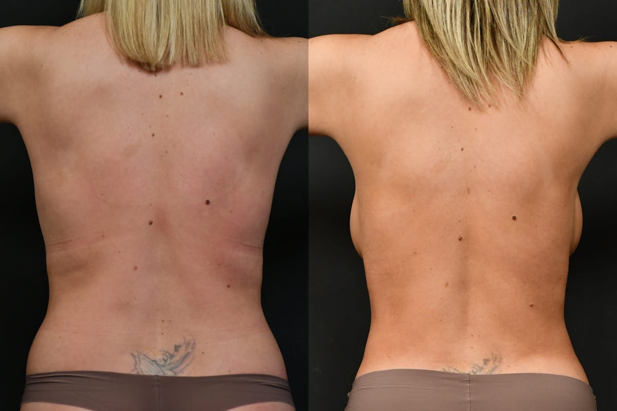 Liposuction / BodyTite Before & After Gallery - Patient 227263 - Image 6