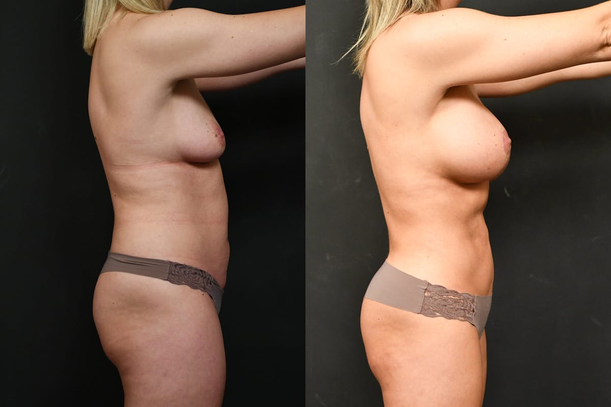 Liposuction Before & After Gallery - Patient 227263 - Image 5