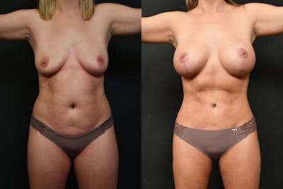 Liposuction / BodyTite Before & After Gallery - Patient 227263 - Image 1