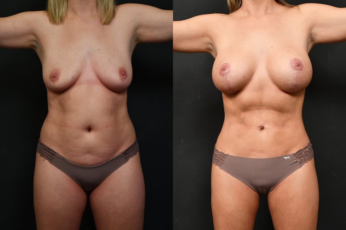 Liposuction Before & After Gallery - Patient 227263 - Image 1