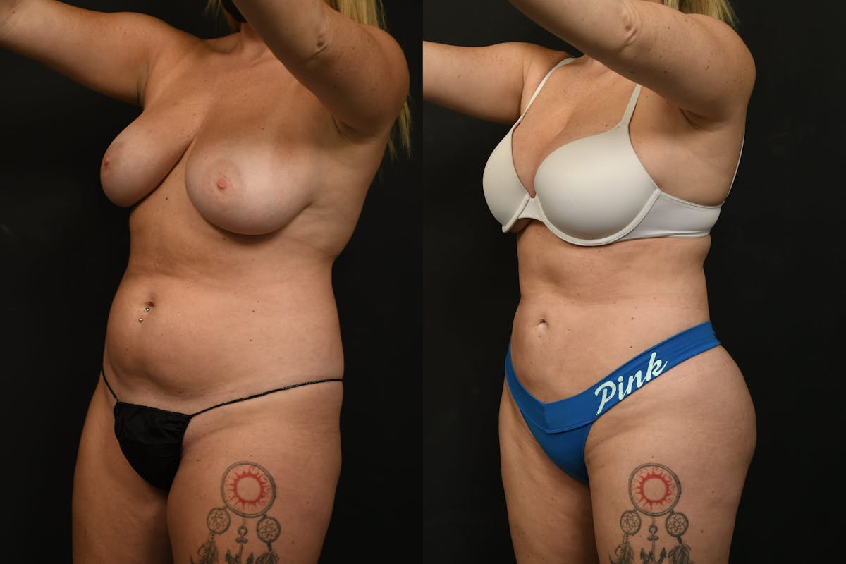 Liposuction / BodyTite Before & After Gallery - Patient 382681 - Image 2