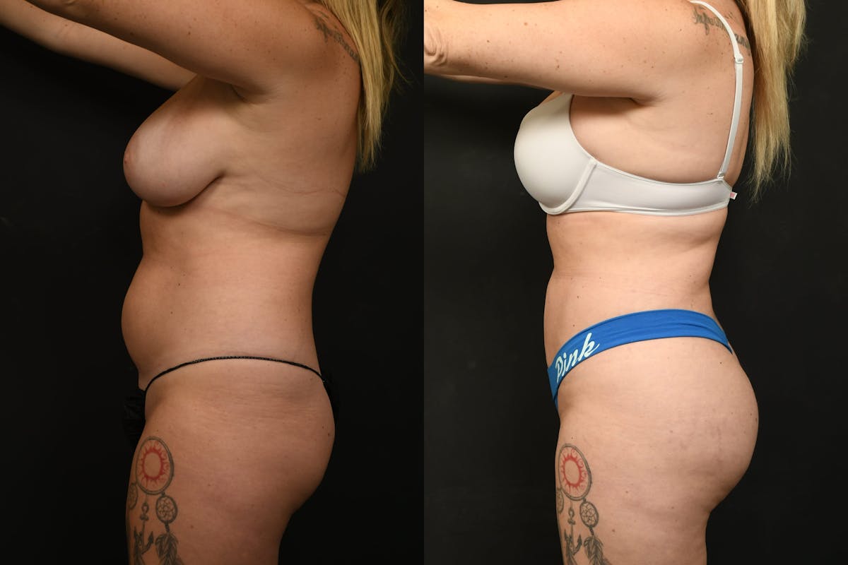 Liposuction / BodyTite Before & After Gallery - Patient 382681 - Image 3