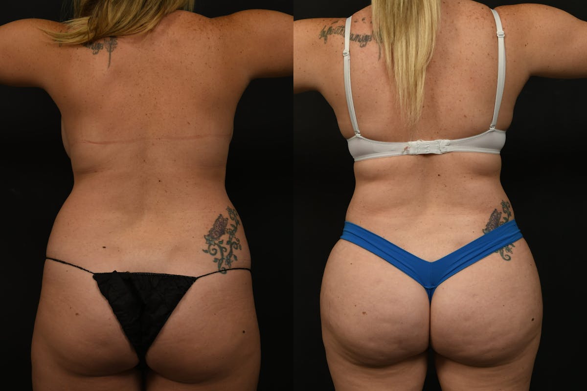 Liposuction / BodyTite Before & After Gallery - Patient 382681 - Image 4