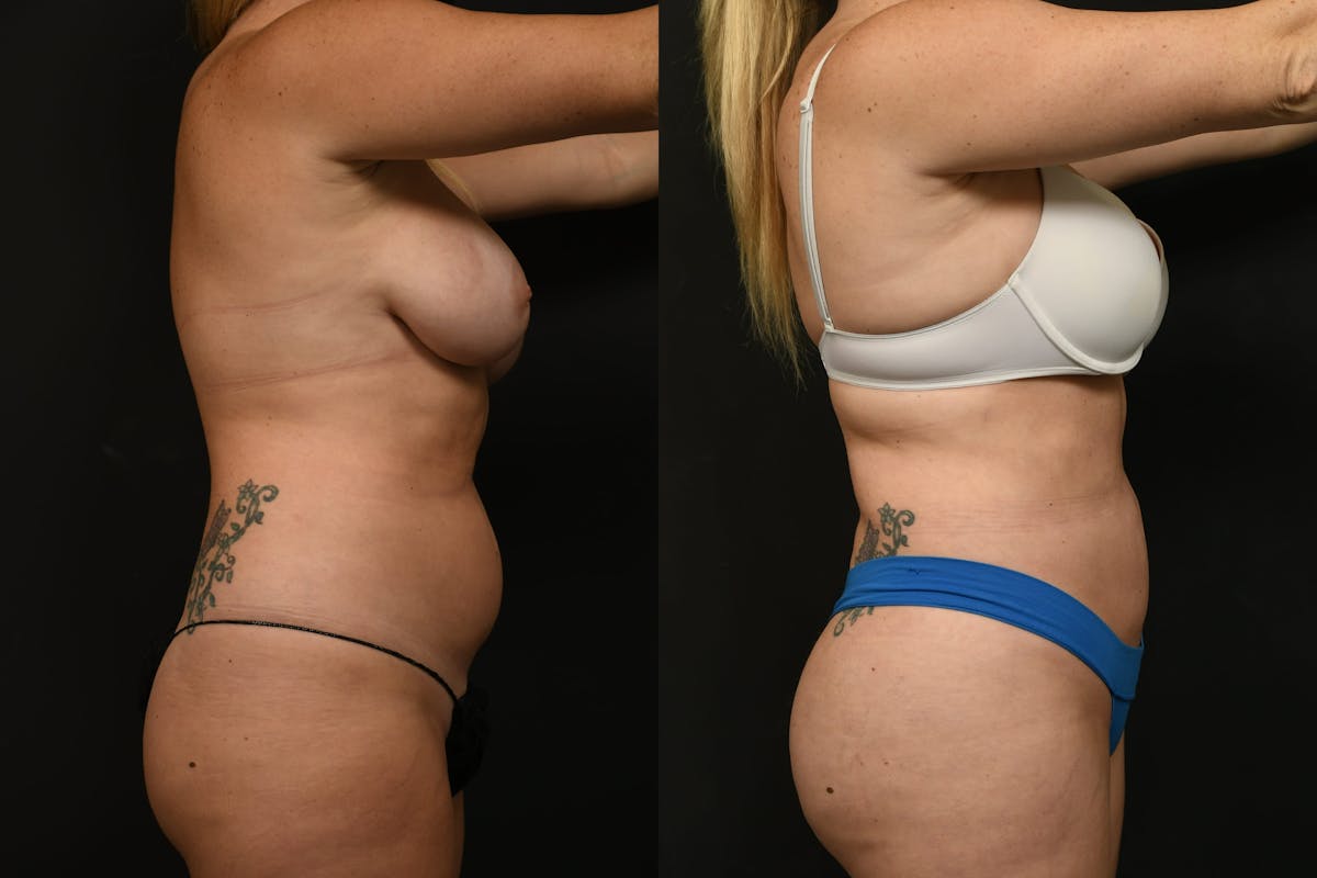 Liposuction / BodyTite Before & After Gallery - Patient 382681 - Image 5