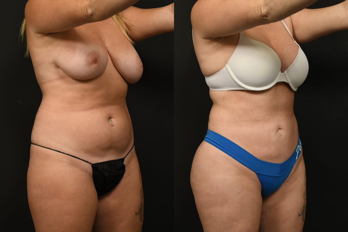 Liposuction Before & After Gallery - Patient 382681 - Image 6