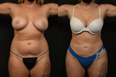 Liposuction / BodyTite Before & After Gallery - Patient 382681 - Image 1