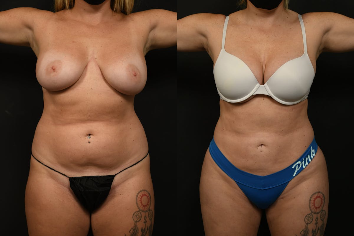 Liposuction Before & After Gallery - Patient 382681 - Image 1