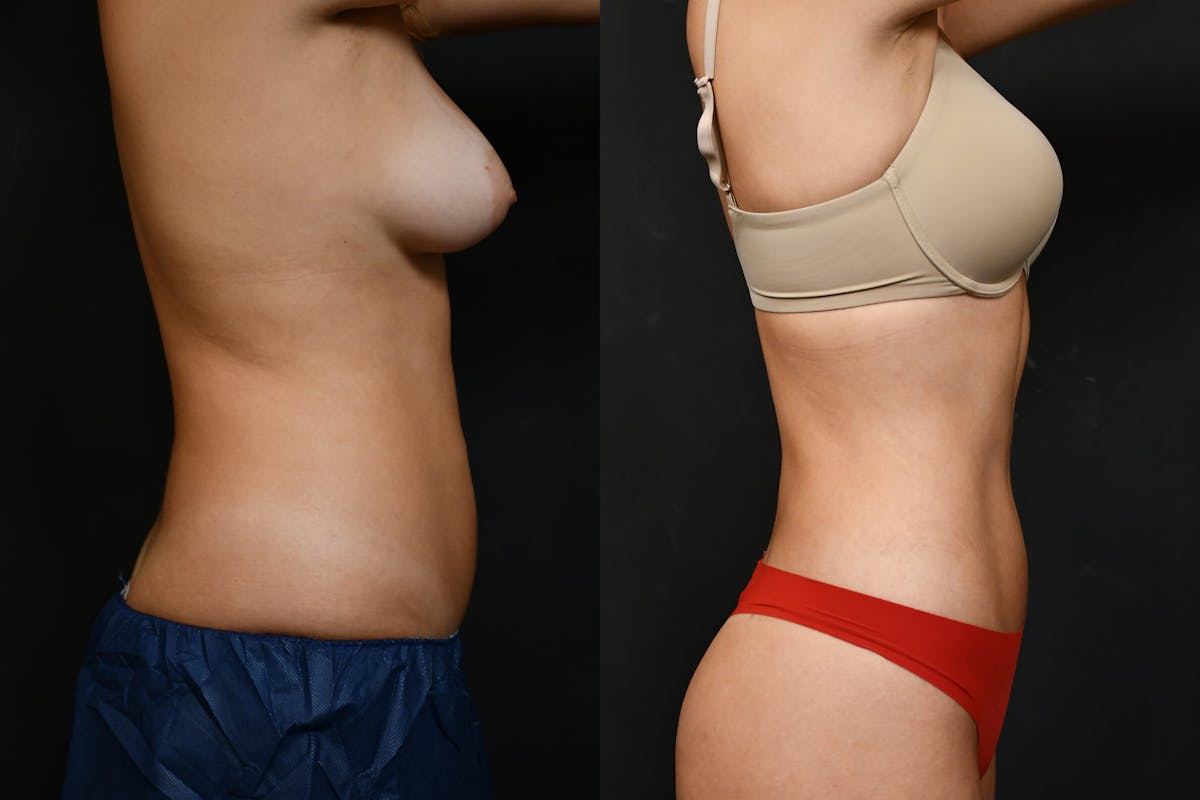 Liposuction Before & After Gallery - Patient 210260 - Image 3