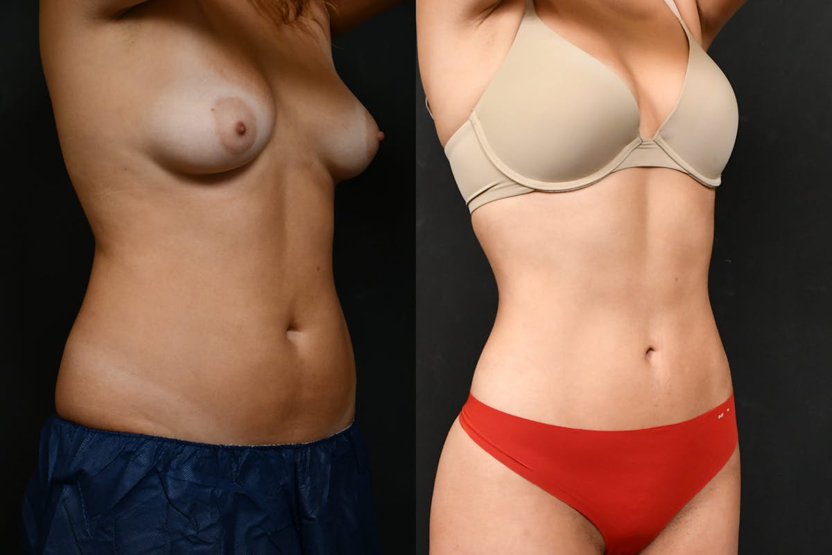 Liposuction Before & After Gallery - Patient 210260 - Image 2