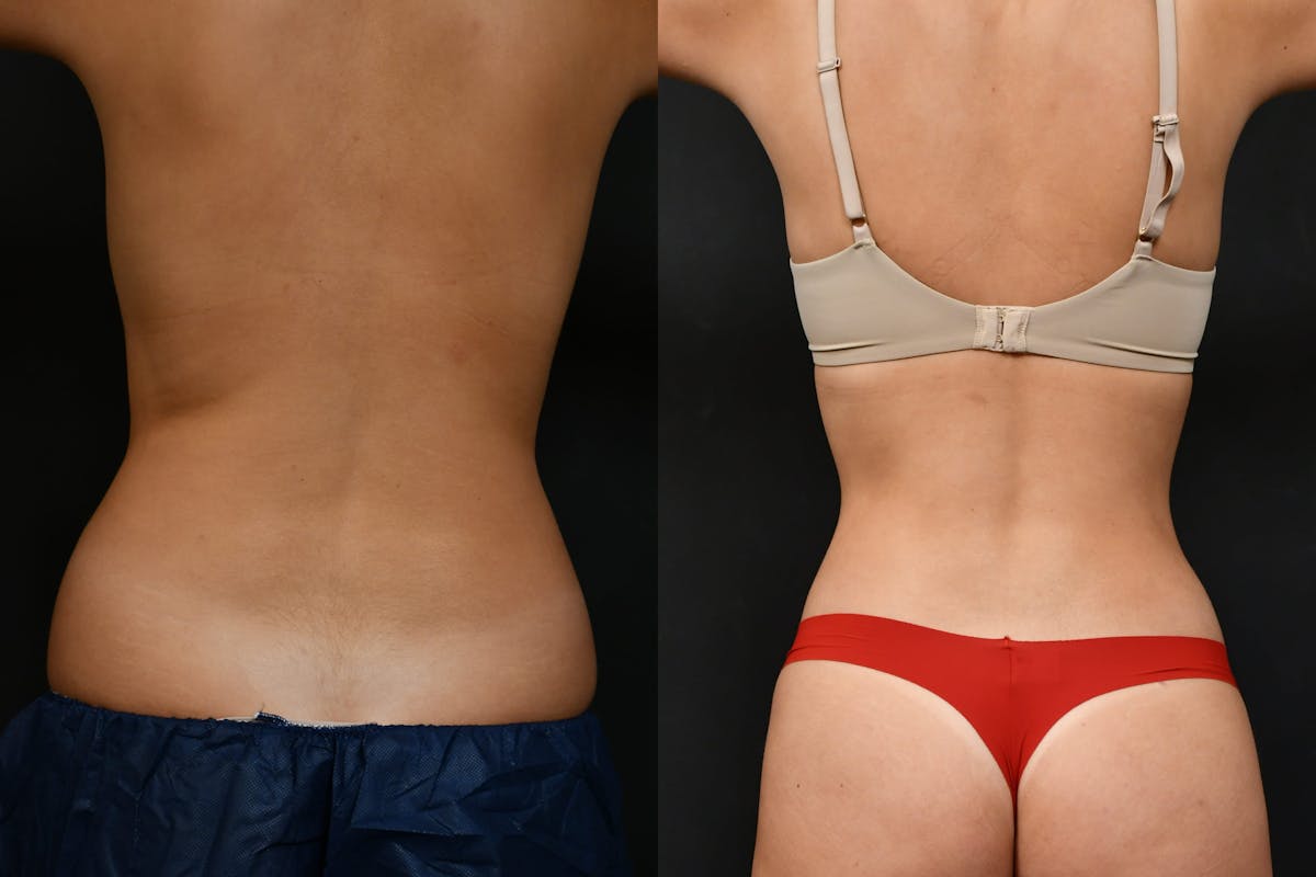 Liposuction / BodyTite Before & After Gallery - Patient 210260 - Image 6