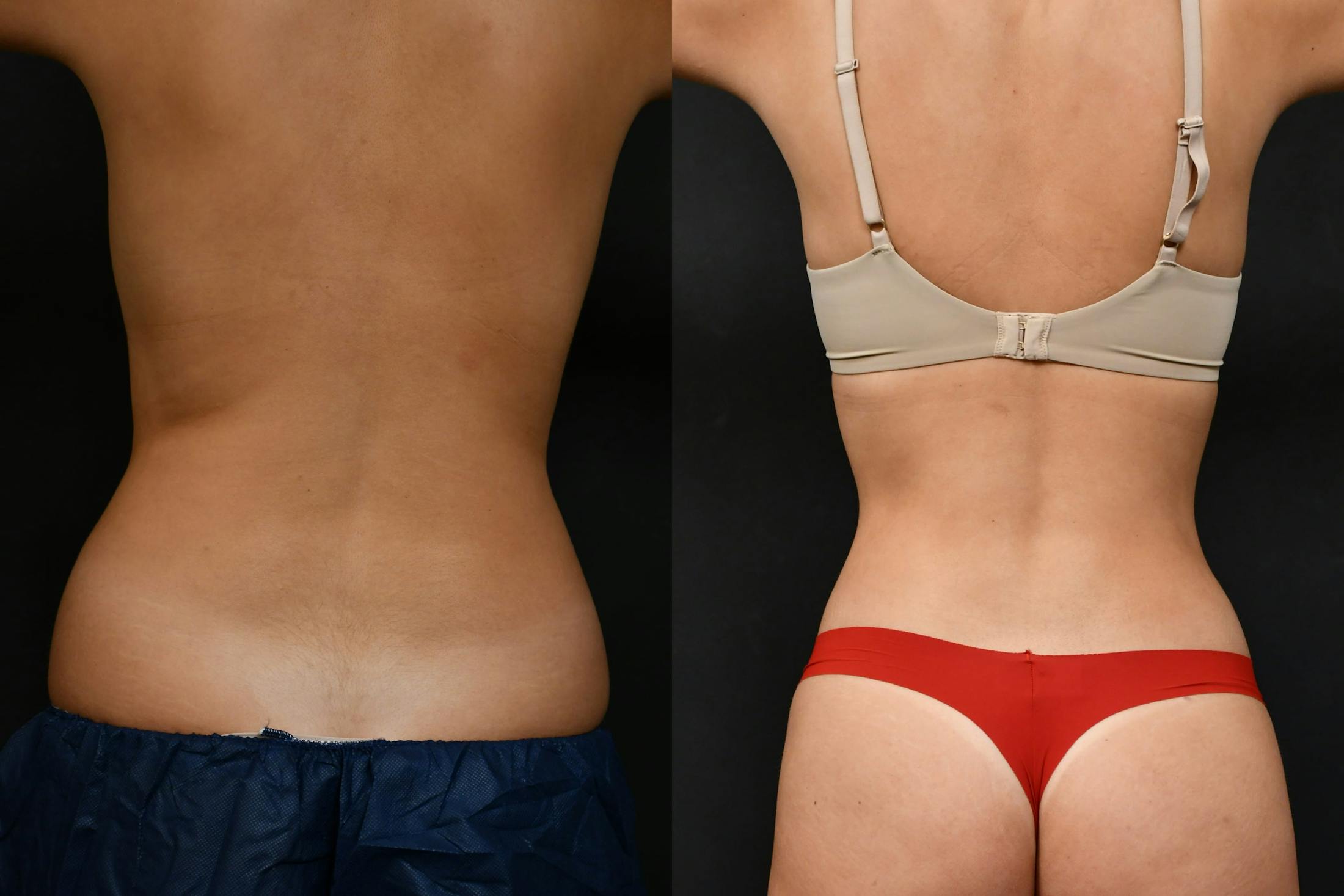 Liposuction / BodyTite Before & After Gallery - Patient 210260 - Image 6