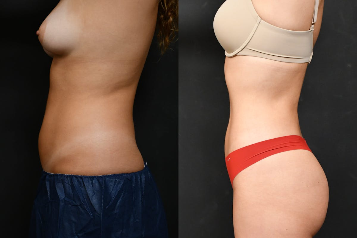 Liposuction Before & After Gallery - Patient 210260 - Image 5