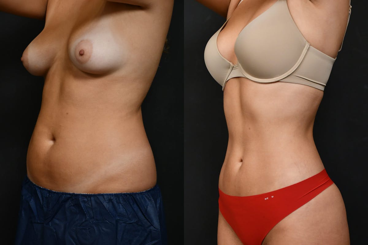Liposuction Before & After Gallery - Patient 210260 - Image 4