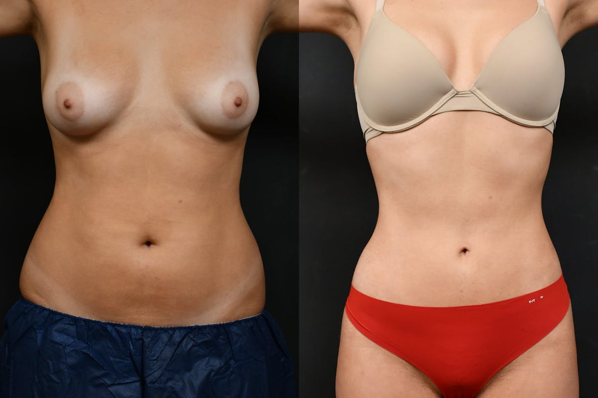 Liposuction Before & After Gallery - Patient 210260 - Image 1