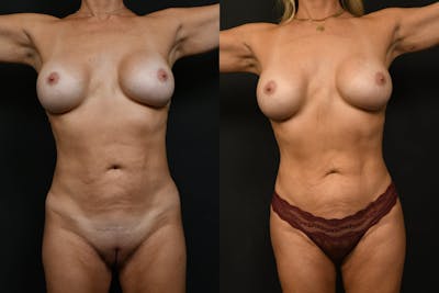 Non-Surgical Before & After Gallery - Patient 920177 - Image 1