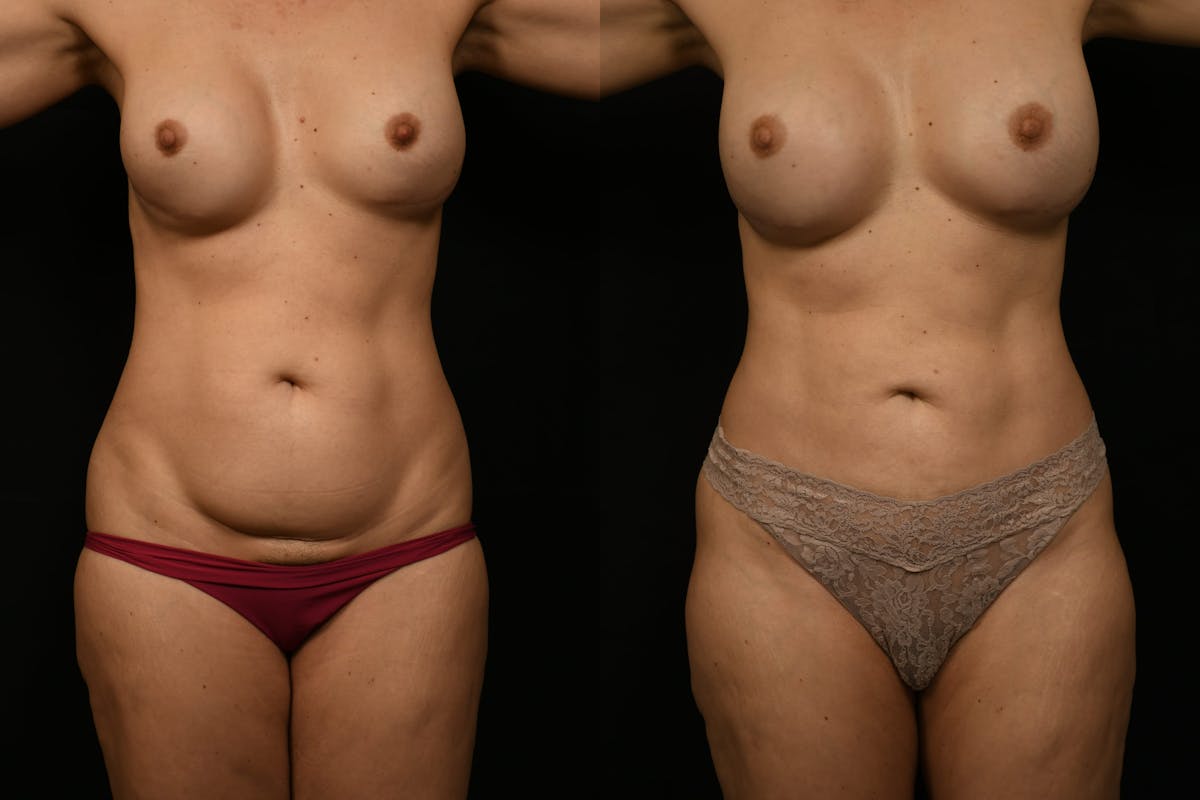 Liposuction / BodyTite Before & After Gallery - Patient 285479 - Image 1