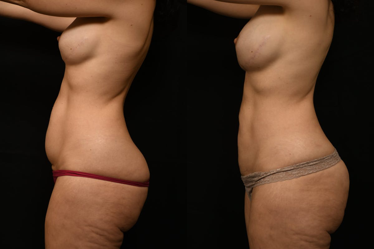 Liposuction / BodyTite Before & After Gallery - Patient 285479 - Image 3