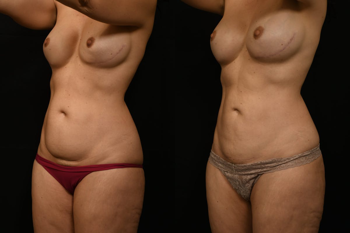 Liposuction / BodyTite Before & After Gallery - Patient 285479 - Image 2